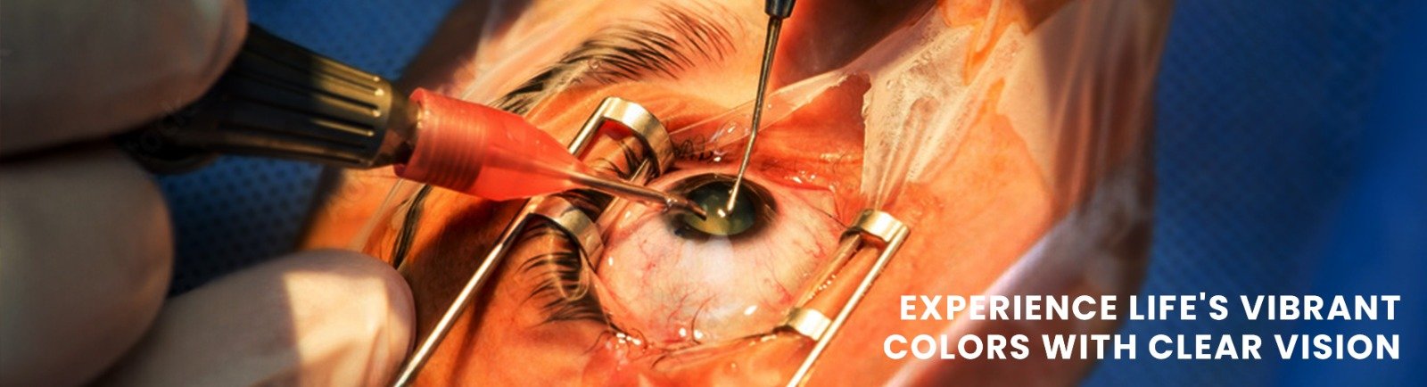 Cataract Surgery